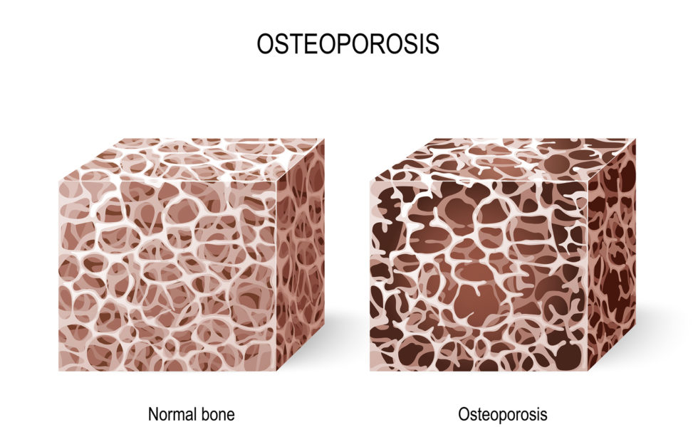Bone health. Osteoporosis. Vector illustration for your design and medical use. Different views of a bone tissue (normal and osteoporosis). Disease of bones that leads to an increased risk of fracture. Cross section. Human anatomy.